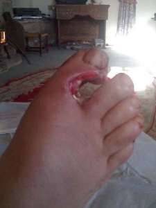 45-inch-hole-plus-peripheral-trauma