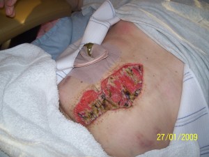 June 2009 Ileostomy